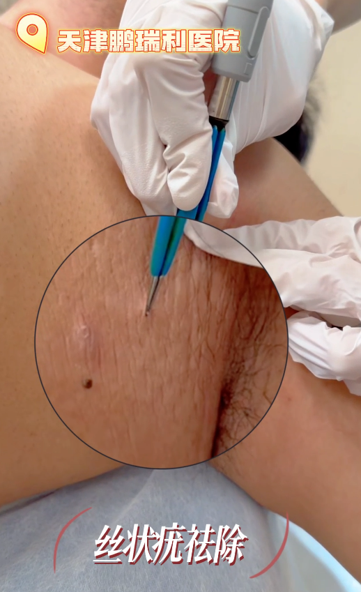 Filiform warts [small flesh bumps] removal process video